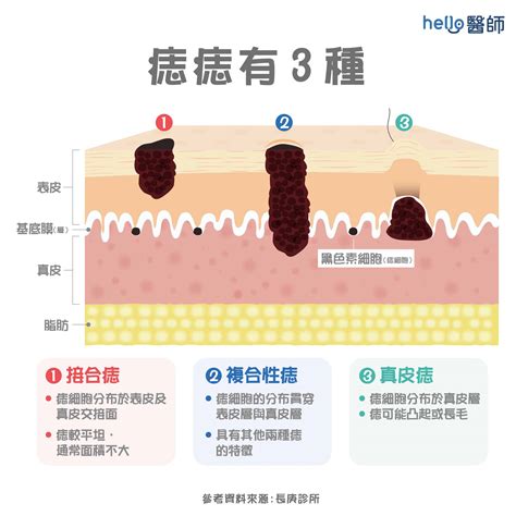 如何消痣|為什麼臉上的痣越來越多？皮膚科醫師解析長痣原因、。